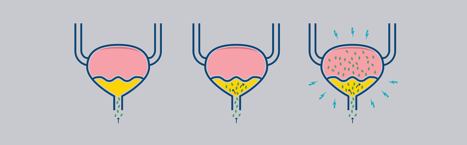 Illustration of how bacteria infect the bladder in a urinary tract infection Illustration of how bacteria infect the bladder in a urinary tract infection
